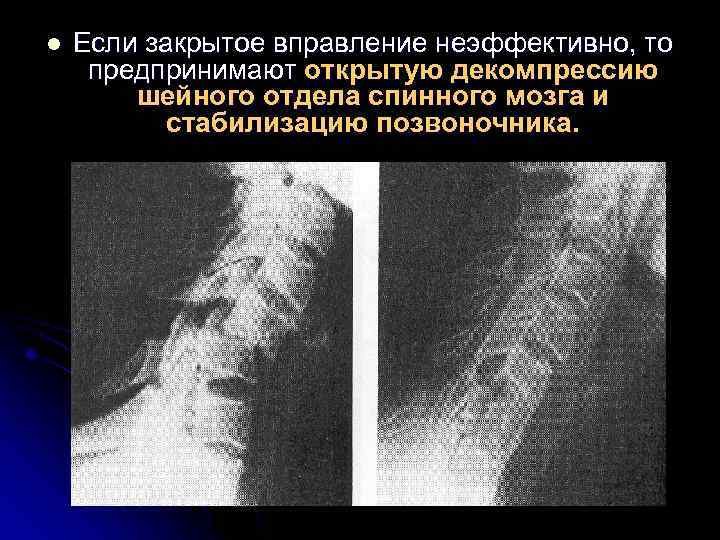 l Если закрытое вправление неэффективно, то предпринимают открытую декомпрессию шейного отдела спинного мозга и