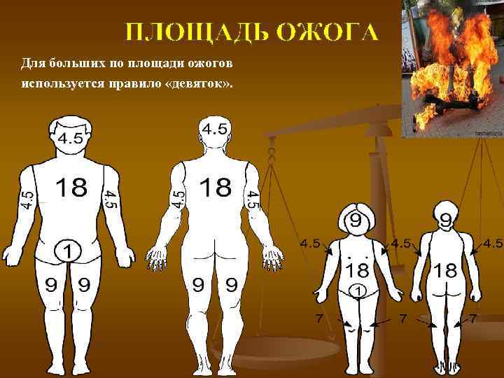 ПЛОЩАДЬ ОЖОГА Для больших по площади ожогов используется правило «девяток» . 