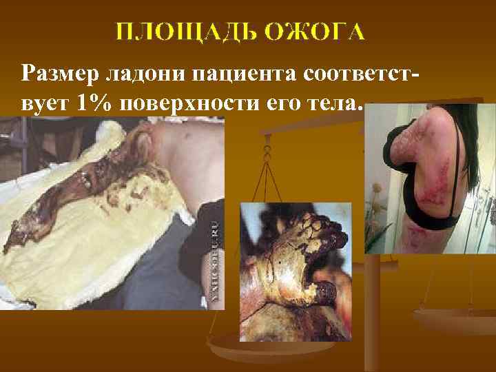 ПЛОЩАДЬ ОЖОГА Размер ладони пациента соответствует 1% поверхности его тела. 