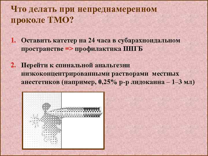 Что делать при непреднамеренном проколе ТМО? 1. Оставить катетер на 24 часа в субарахноидальном