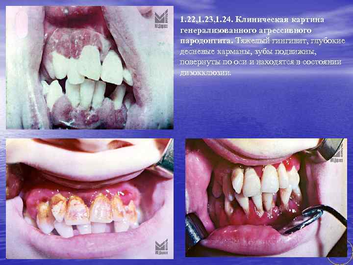 1. 22, 1. 23, 1. 24. Клиническая картина генерализованного агрессивного пародонтита. Тяжелый гингивит, глубокие