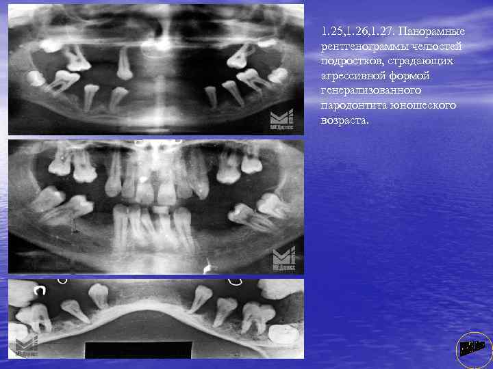 1. 25, 1. 26, 1. 27. Панорамные рентгенограммы челюстей подростков, страдающих агрессивной формой генерализованного