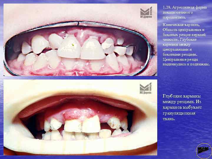 1. 28. Агрессивная форма локализованного пародонтита. Клиическая картина, Область центральных и боковых резцов верхней