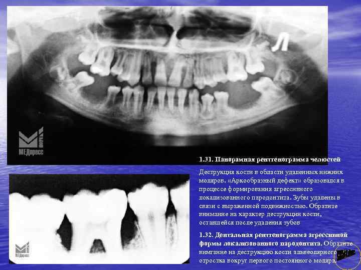 1. 31. Панорамная рентгенограмма челюстей Деструкция кости в области удаленных нижних моляров. «Аркообразный дефект»