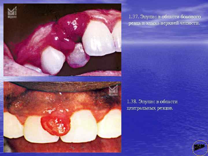 1. 37. Эпулис в области бокового резца и клыка верхней челюсти. 1. 38. Эпулис