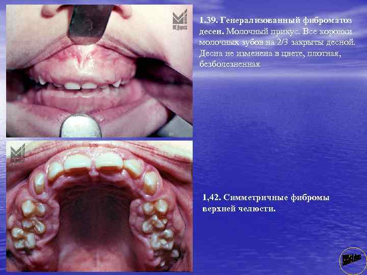 1. 39. Генерализованный фиброматоз десен. Молочный прикус. Все коронки молочных зубов на 2/3 закрыты
