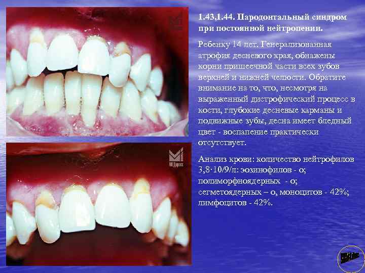 1. 43, 1. 44. Пародонтальный синдром при постоянной нейтропении. Ребенку 14 лет. Генерализованная атрофия