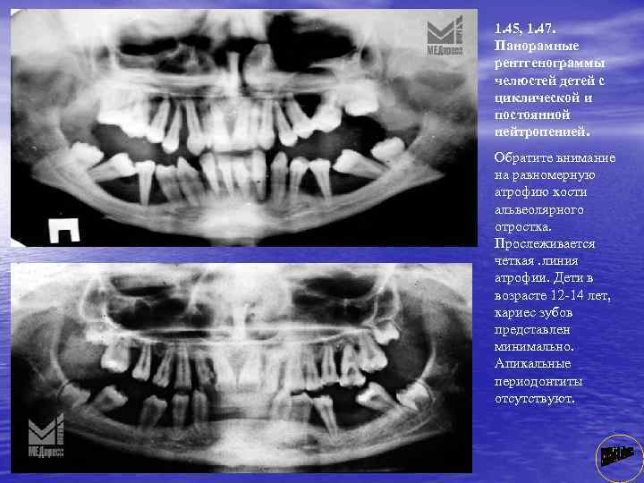 1. 45, 1. 47. Панорамные рентгенограммы челюстей детей с циклической и постоянной нейтропенией. Обратите