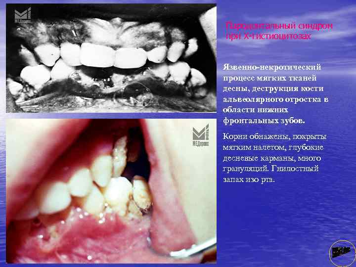 Пародонтальный синдром при Х гистиоцитозах Язвенно-некротический процесс мяrкиx тканей десны, деструкция кости альвеолярного отростка