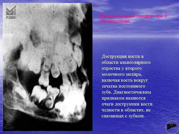 Пародонтальный синдром при Х гистиоцитозах Деструкция кости в области альвеолярного отростка у второго молочного