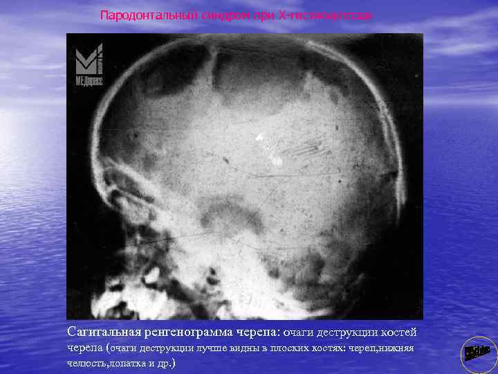 Пародонтальный синдром при Х гистиоцитозах Сагитальная ренгенограмма черепа: очаги деструкции костей черепа (очаги деструкции