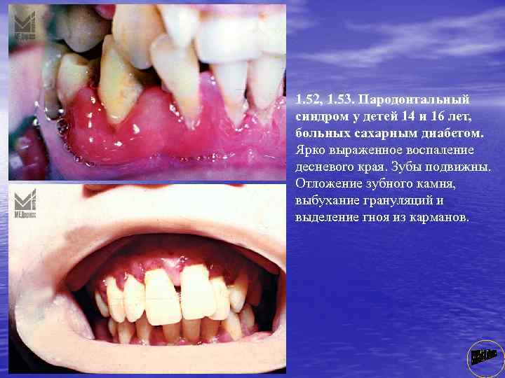 1. 52, 1. 53. Пародонтальный синдром у детей 14 и 16 лет, больных сахарным