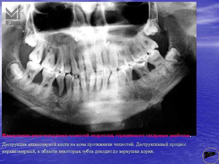 Панорамная рентгенограмма челюстей подростка, страдающего сахарным диабетом. Деструкция альвеолярной кости на всем протяжении челюстей.