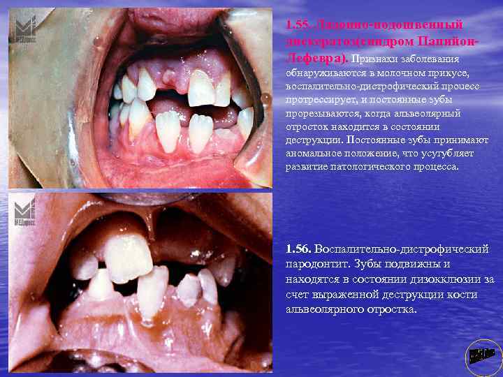 1. 55. Ладонно-подошвенный дискератоз(синдром Папийон. Лефевра). Признаки заболевания обнаруживаются в молочном прикусе, воспалительно дистрофический