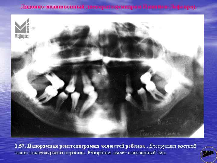 Ладонно-подошвенный дискератоз(синдром Папийон-Лефевра). 1. 57. Панорамная рентгенограмма челюстей ребенка. Деструкция костной ткани альвеолярного отростка.