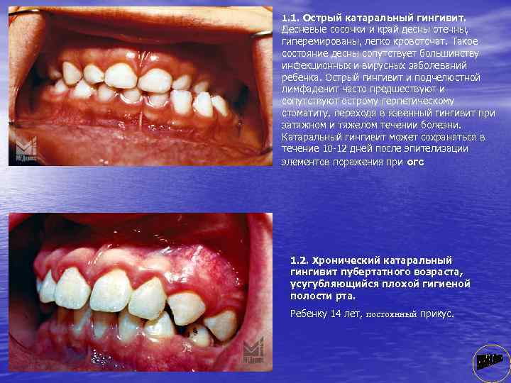 1. 1. Острый катаральный гингивит. Десневые сосочки и край десны отечны, гиперемированы, легко кровоточат.