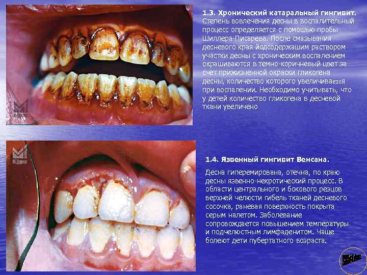 1. 3. Хронический катаральный гингивит. Степень вовлечения десны в воспалительный процесс определяется с помошью