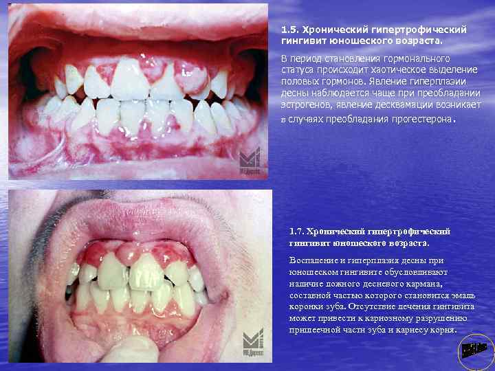 1. 5. Хронический гипертрофический гингивит юношеского возраста. В период становления гормонального статуса происходит хаотическое