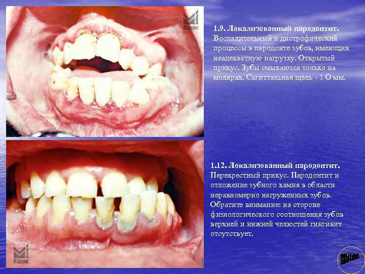 1. 9. Локализованный пародонтит. Воспалительный и дистрофический процессы в пародонте зубов, имеющих неадекватную нагрузку.