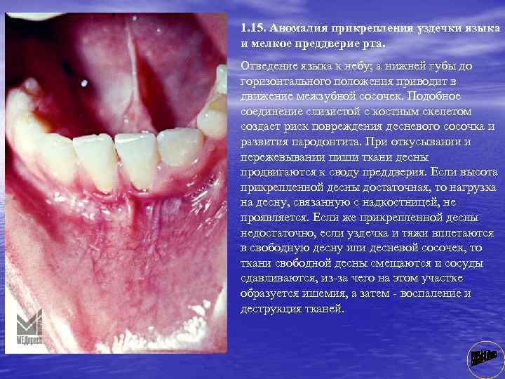 1. 15. Аномалия прикрепления уздечки языка и мелкое преддверие рта. Отведение языка к небу;