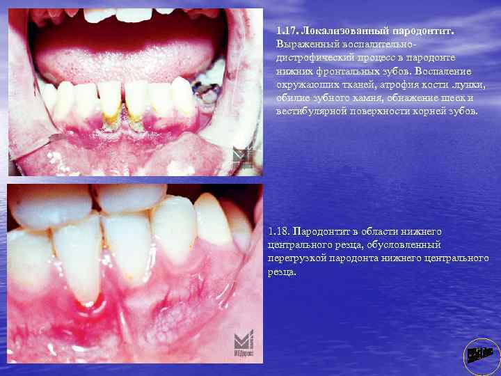 1. 17. Локализованный пародонтит. Выраженный воспалительно дистрофический процесс в пародонте нижних фронтальных зубов. Воспаление