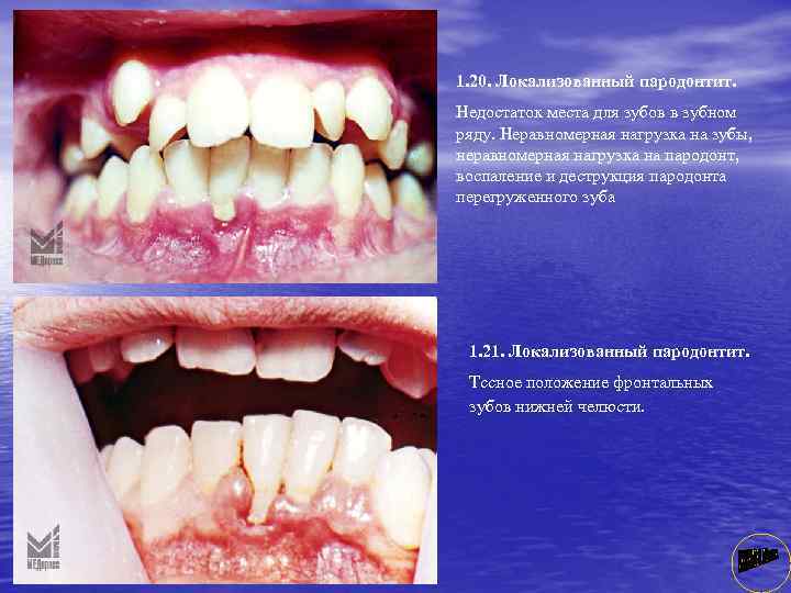 1. 20. Локализованный пародонтит. Недостаток места для зубов в зубном ряду. Неравномерная нагрузка на
