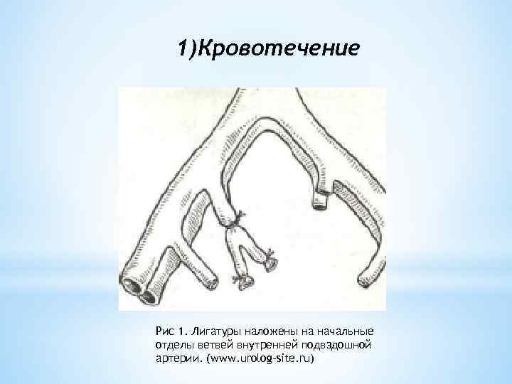 1)Кровотечение Рис 1. Лигатуры наложены на начальные отделы ветвей внутренней подвздошной артерии. (www. urolog-site.