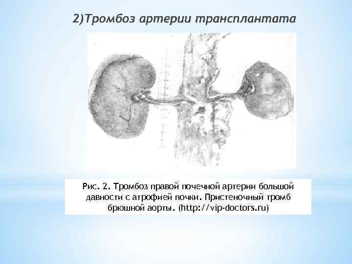 Тромбоз почек. Тромбоз почечной артерии микропрепарат. Тромбоэмболия почечных артерий. Тромбоз почечной артерии гистология. Сегментарный инфаркт почки.