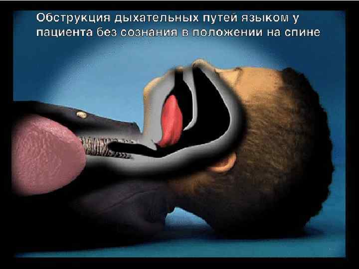 Обструкция дыхательных путей 