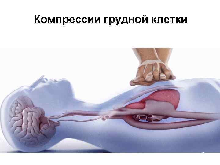 Компрессии грудной клетки 