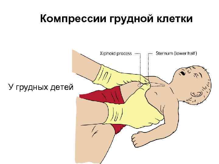 Компрессии грудной клетки У грудных детей 