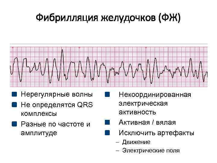 Фибрилляция желудочков (ФЖ) Нерегулярные волны Не определятся QRS комплексы Разные по частоте и амплитуде