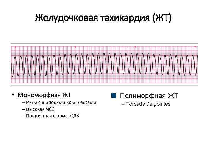 Желудочковая тахикардия экг фото