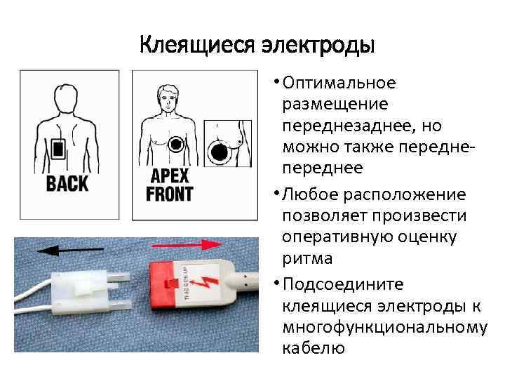 Клеящиеся электроды • Оптимальное размещение переднезаднее, но можно также переднее • Любое расположение позволяет