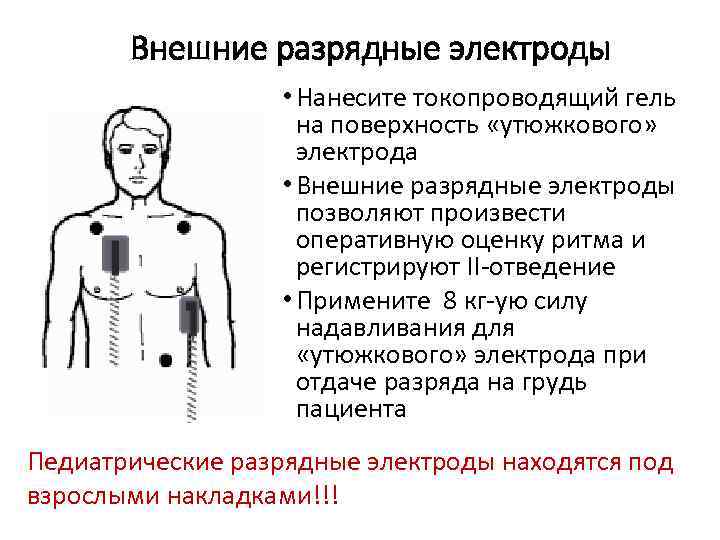 Внешние разрядные электроды • Нанесите токопроводящий гель на поверхность «утюжкового» электрода • Внешние разрядные