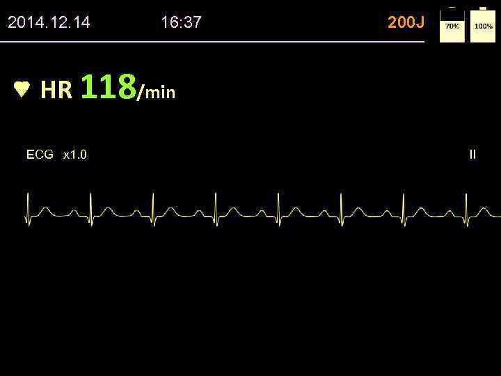 2014. 12. 14 16: 37 200 J HR 118/min ECG x 1. 0 II