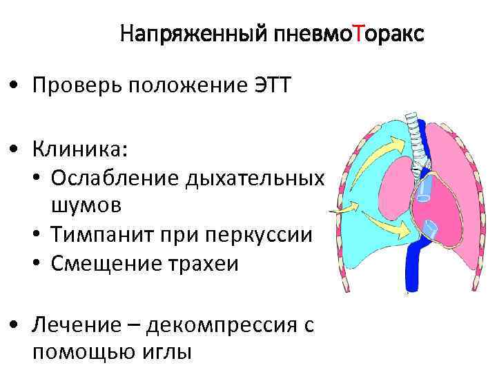 Напряженный пневмо. Торакс • Проверь положение ЭТТ • Клиника: • Ослабление дыхательных шумов •