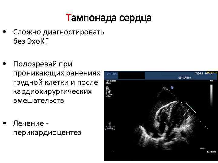 Тампонада сердца • Сложно диагностировать без Эхо. КГ • Подозревай при проникающих ранениях грудной