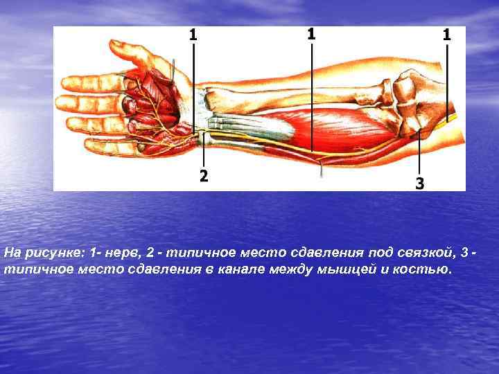  На рисунке: 1 - нерв, 2 - типичное место сдавления под связкой, 3
