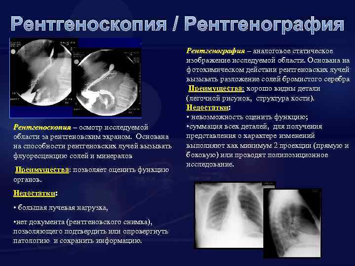 Рентгеноскопия / Рентгенография Рентгеноскопия – осмотр исследуемой – области за рентгеновским экраном. Основана на