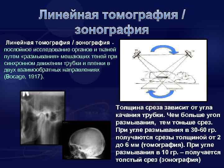 Линейная томография / зонография послойное исследование органов и тканей путем «размывания» мешающих теней при