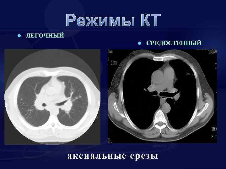 Режимы КТ l ЛЕГОЧНЫЙ l СРЕДОСТЕННЫЙ аксиальные срезы 