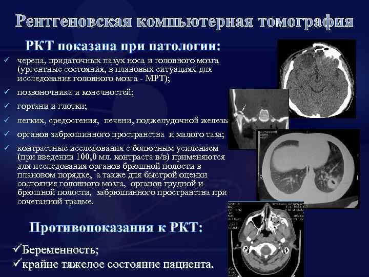 Рентгеновская компьютерная томография РКТ показана при патологии: ü черепа, придаточных пазух носа и головного