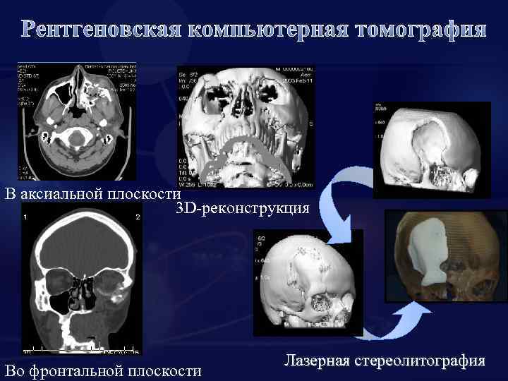 Рентгеновская компьютерная томография В аксиальной плоскости 3 D-реконструкция Во фронтальной плоскости Лазерная стереолитография 