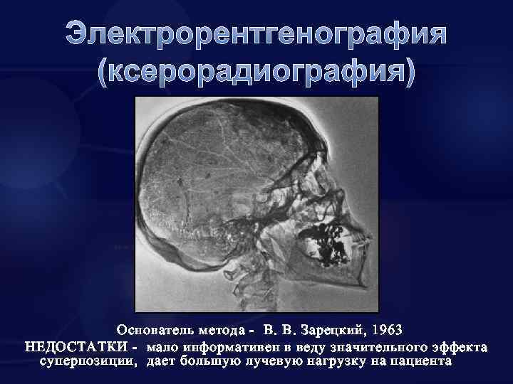 Электрорентгенография (ксерорадиография) Основатель метода - В. В. Зарецкий, 1963 НЕДОСТАТКИ - мало информативен в