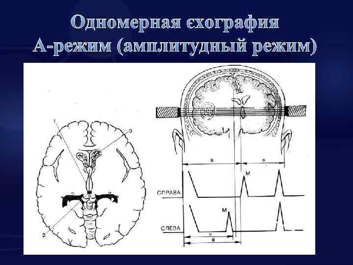 Одномерная эхография А-режим (амплитудный режим) 64 