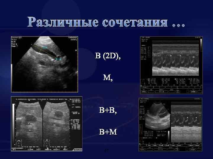 Различные сочетания … В (2 D), M, B+B, B+M 67 