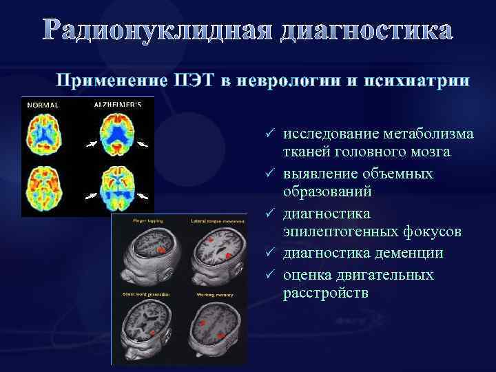 Радионуклидная диагностика Применение ПЭТ в неврологии и психиатрии ü ü ü исследование метаболизма тканей