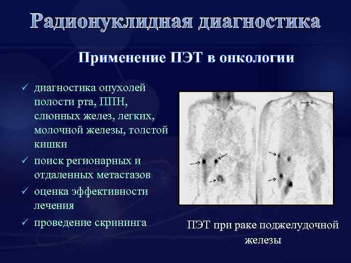 Радионуклидная диагностика Применение ПЭТ в онкологии диагностика опухолей полости рта, ППН, слюнных желез, легких,