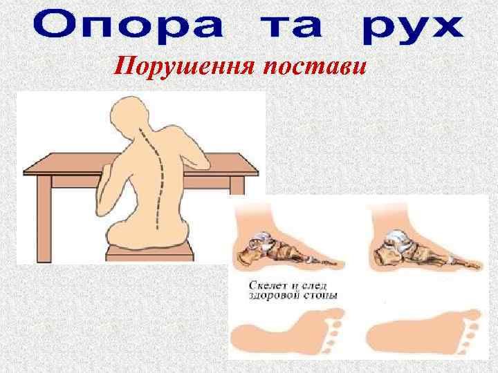 Порушення постави 